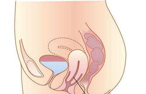 郑州新世纪医院 引起子宫脱垂的六大原因
